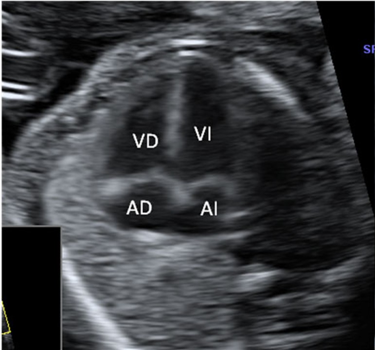 Ecografía Morfológica