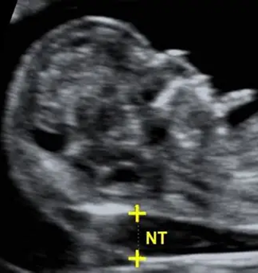 Ecografía Genética